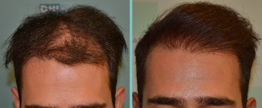 Vorher Nachher – Alex D.