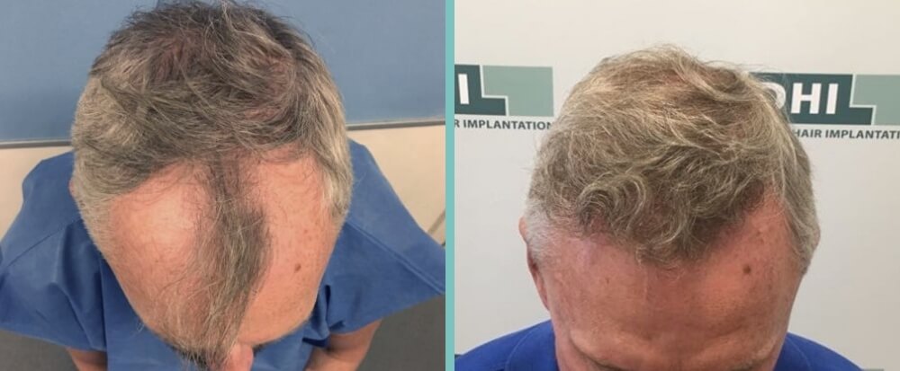 Vorher Nachher – Bernhard G.