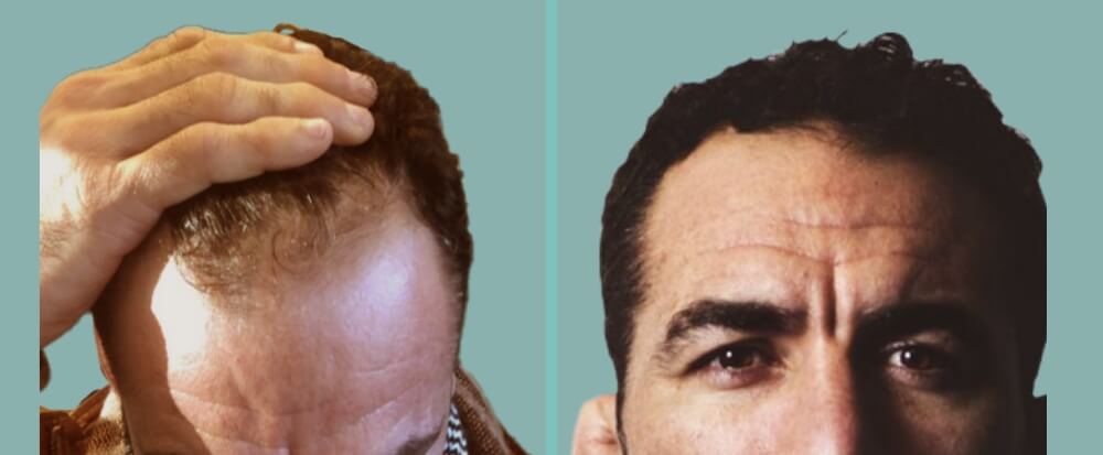 Vorher Nachher – Branco G.