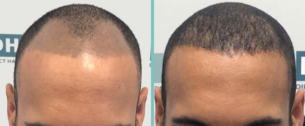 Vorher Nachher – Eyemen S.