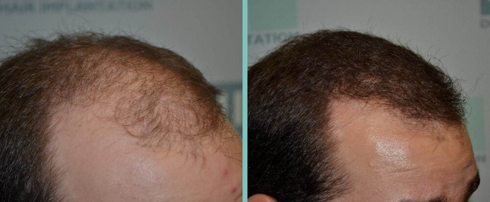 Vorher Nachher – Gernot F.