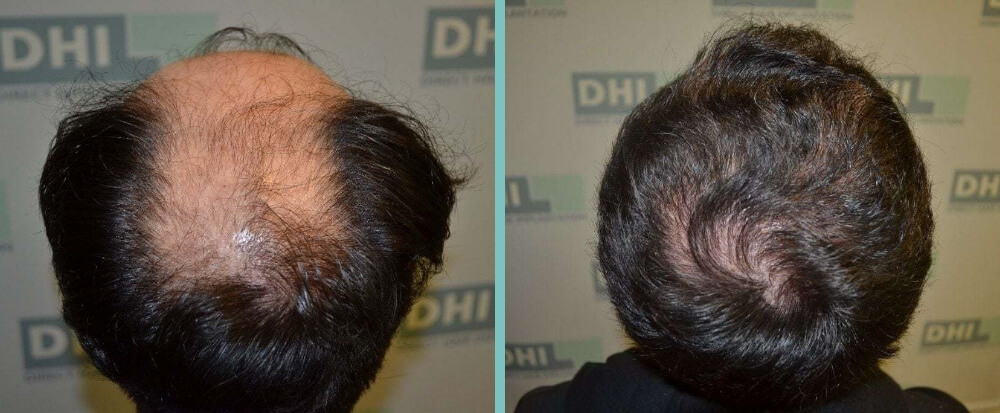 Vorher Nachher – Ivica Z.