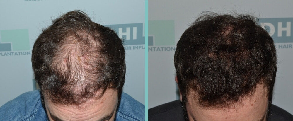 Vorher Nachher – James R.