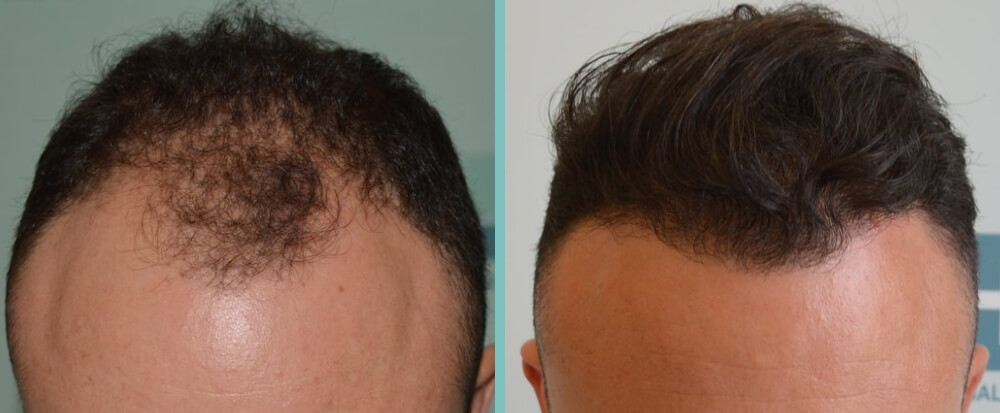 Vorher Nachher – Kristos P.