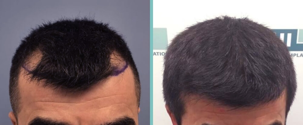 Vorher Nachher – Ludomir C.