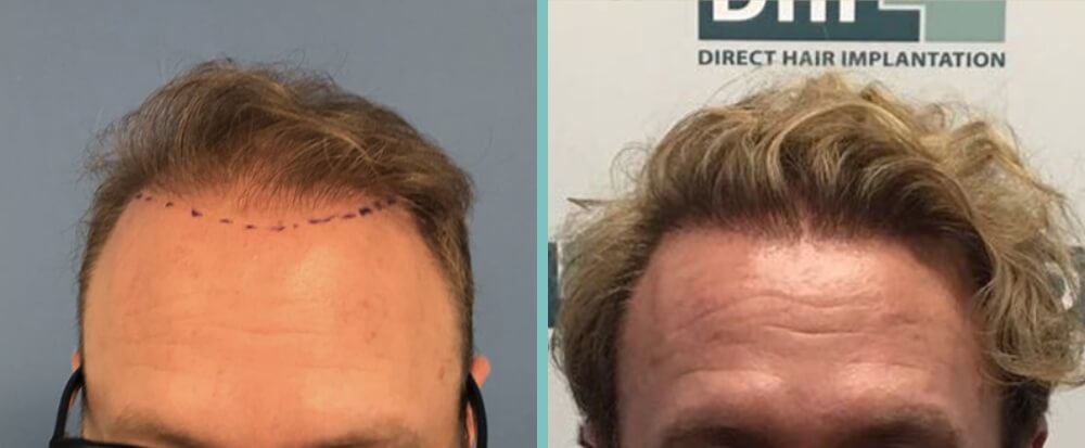 Vorher Nachher – Mark F.