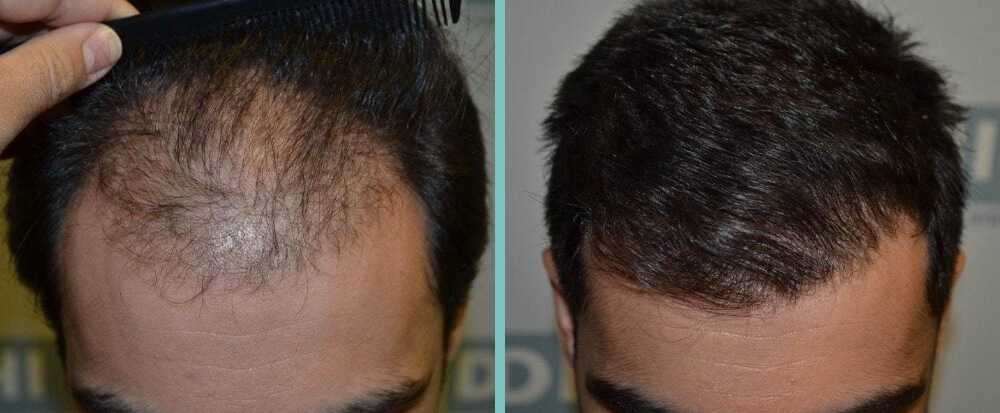 Vorher Nachher – Miromir B.