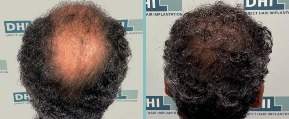 Vorher Nachher – Nikolas V.