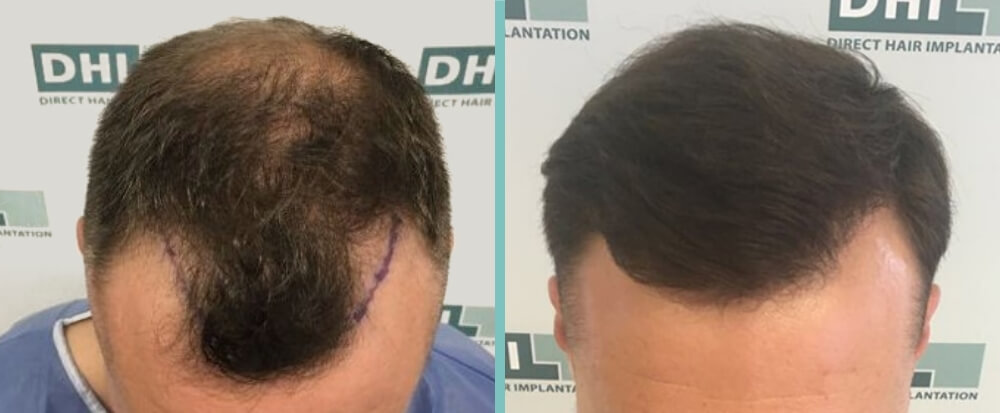 Vorher Nachher – Ronald F.