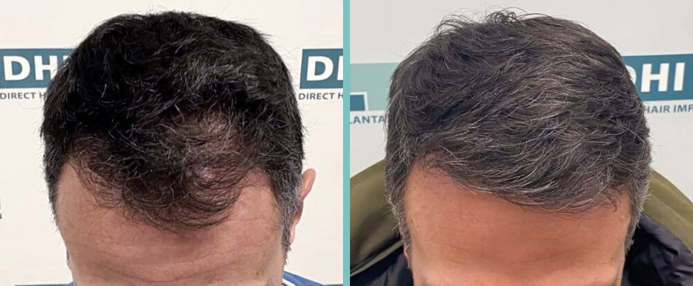 Vorher Nachher – Thomas H.