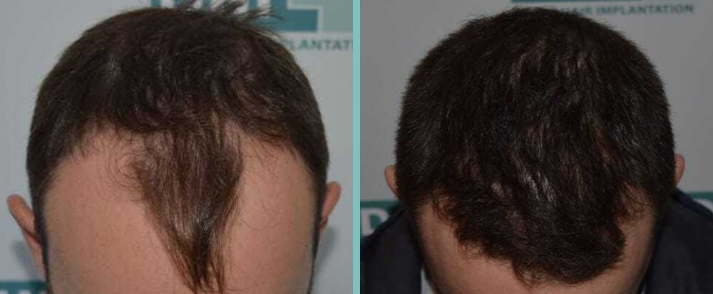 Vorher Nachher – Yasin V.