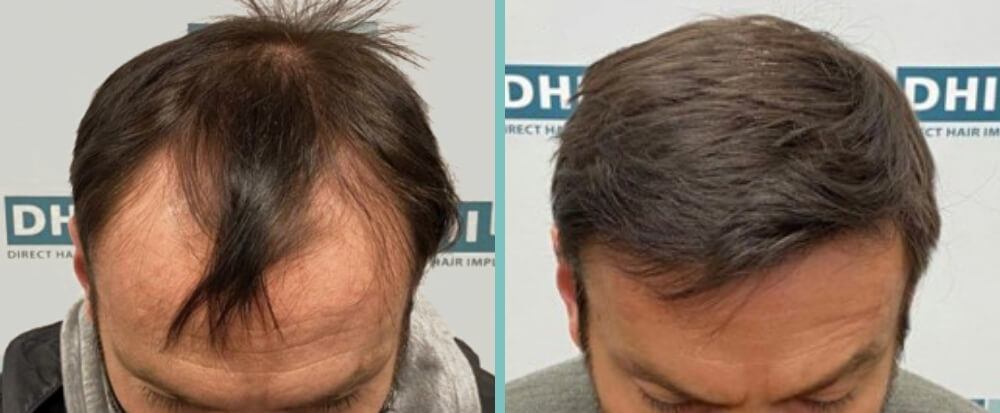 Vorher Nachher – Zoran G.