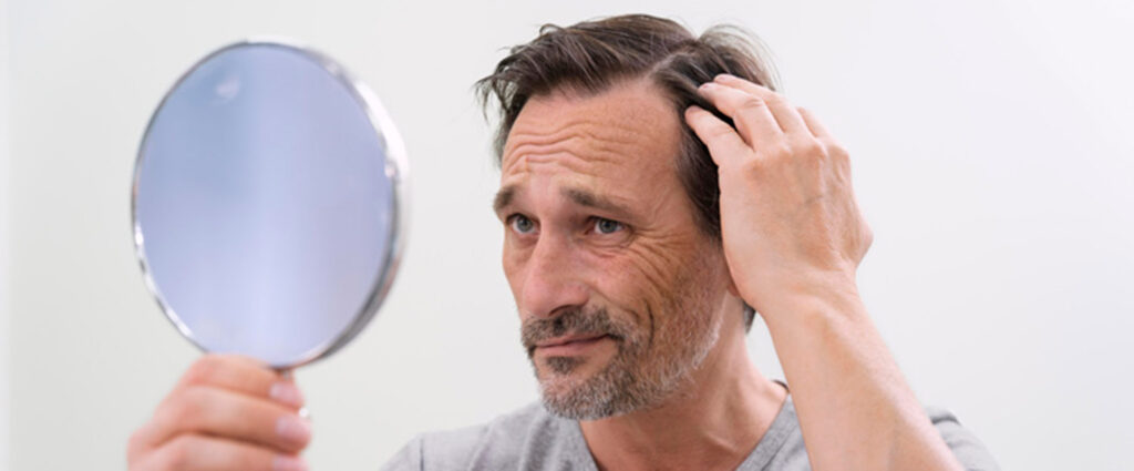 Kreisrunder Haarausfall: Das können Sie tun!