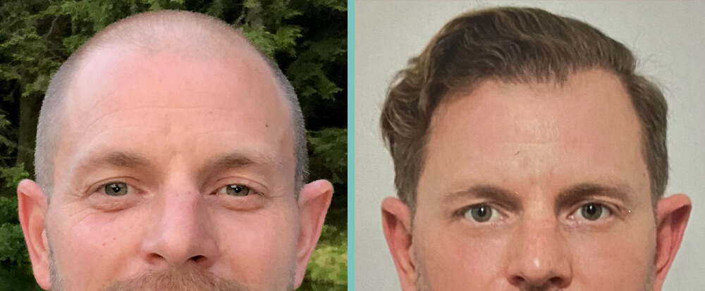 Vorher Nachher – Eric D.