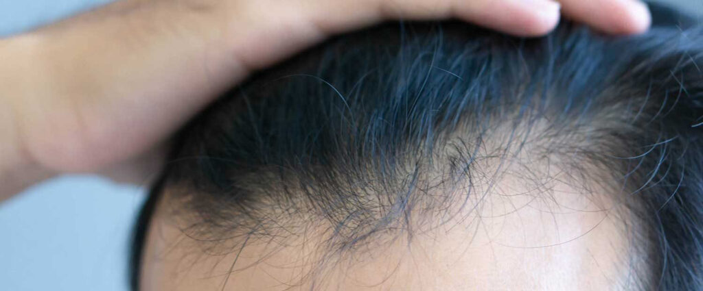 Unshaven  Haarverpflanzung ohne Rasur