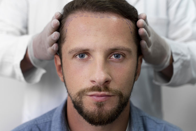 Verständnis der Haartransplantation mit Natalie Lanczmann