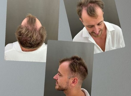 Julienco – vollere Haarpracht statt kaschieren