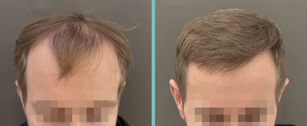 Vorher Nachher – Simon G.