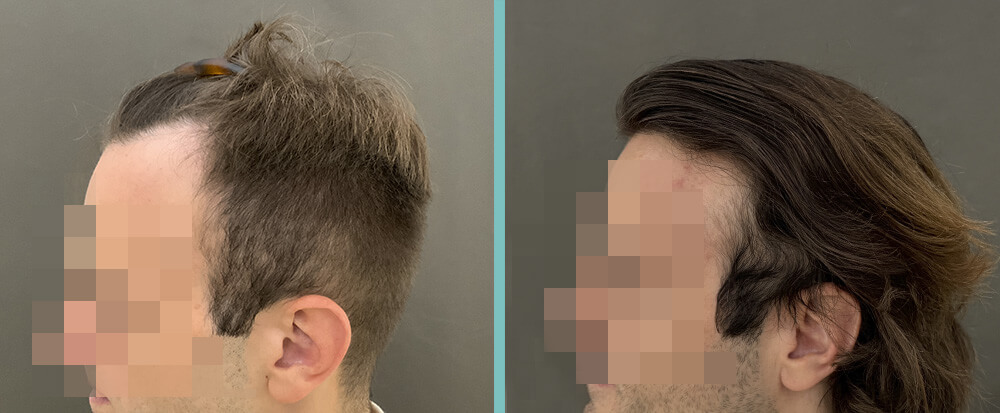 Vorher Nachher – Erich Z.