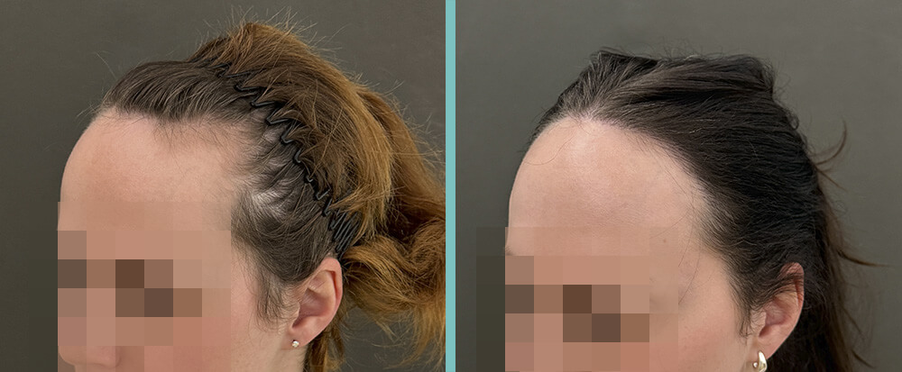 Vorher Nachher – Helga U.