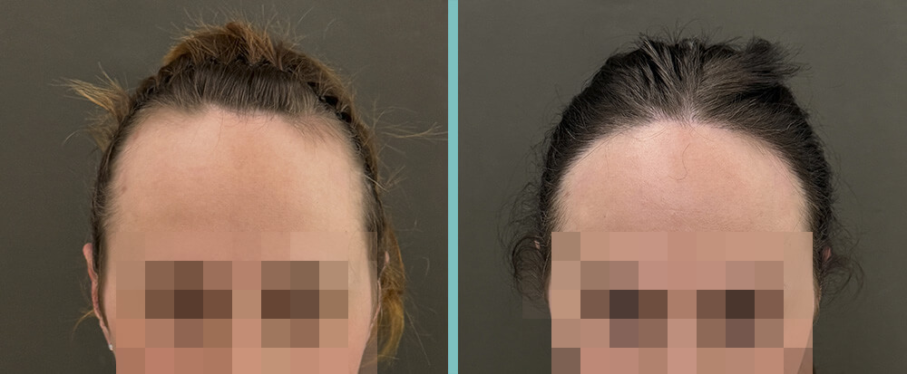 Haartransplantation Frau vorher / nachher