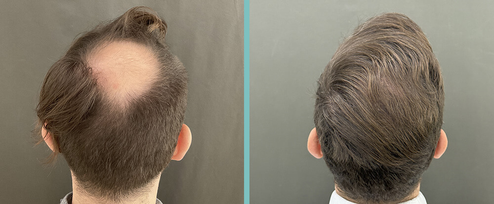 vorher nachher Haartransplantation