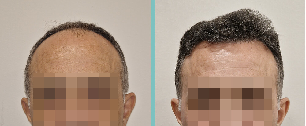 Vorher Nachher – Alfred G.