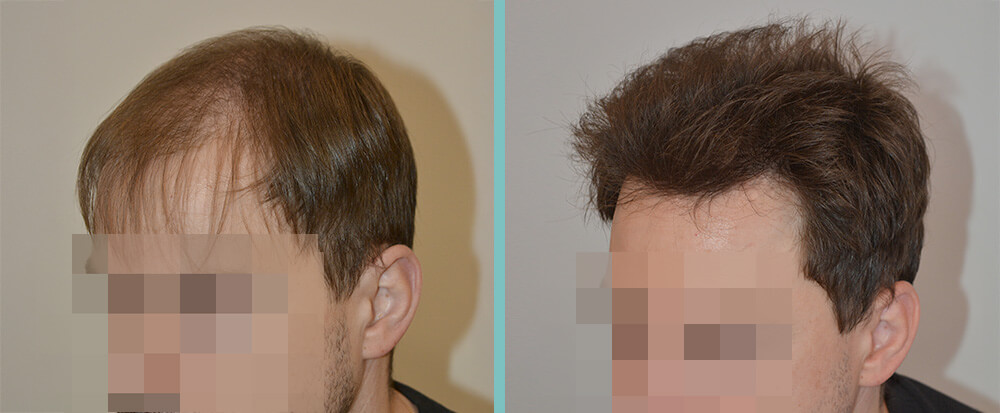 Vorher Nachher – Ernst W.