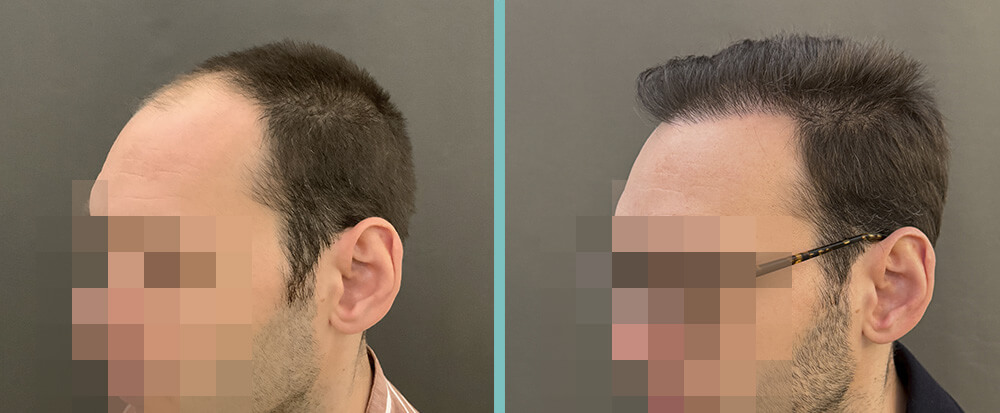 Vorher Nachher – Hannes B.