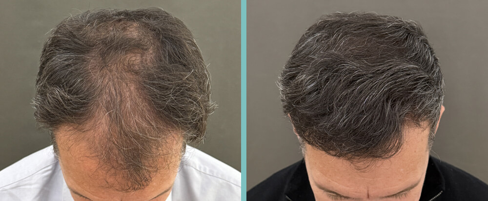 Vorher Nachher – Johannes W.