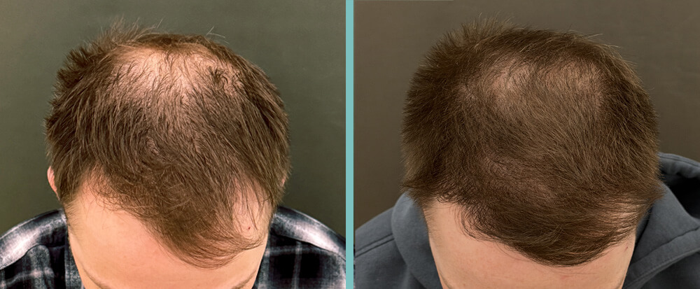 Vorher Nachher – Thomas E.